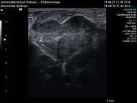 SD-Sonographieherz