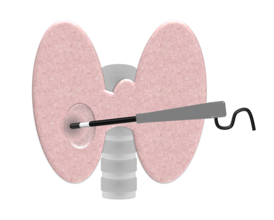 Thermoablation der Schilddrüse